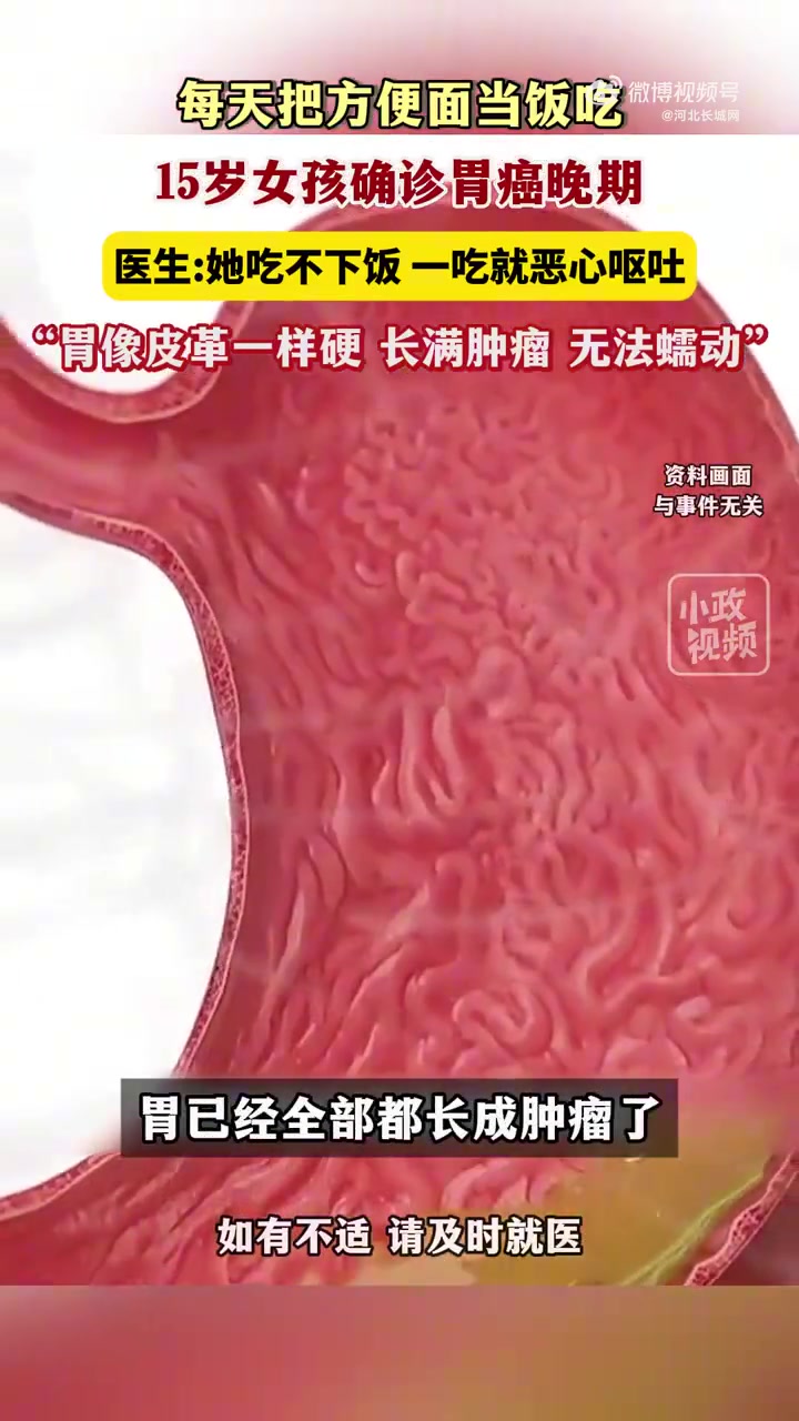 8月25日(发布时间),河南。每天把方便面当饭吃,15岁女孩确诊胃癌晚期,医生:她吃不下饭