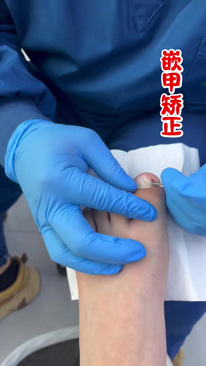 高青哪家鸡眼干疔治的好,老转盘西南角孙氏护足