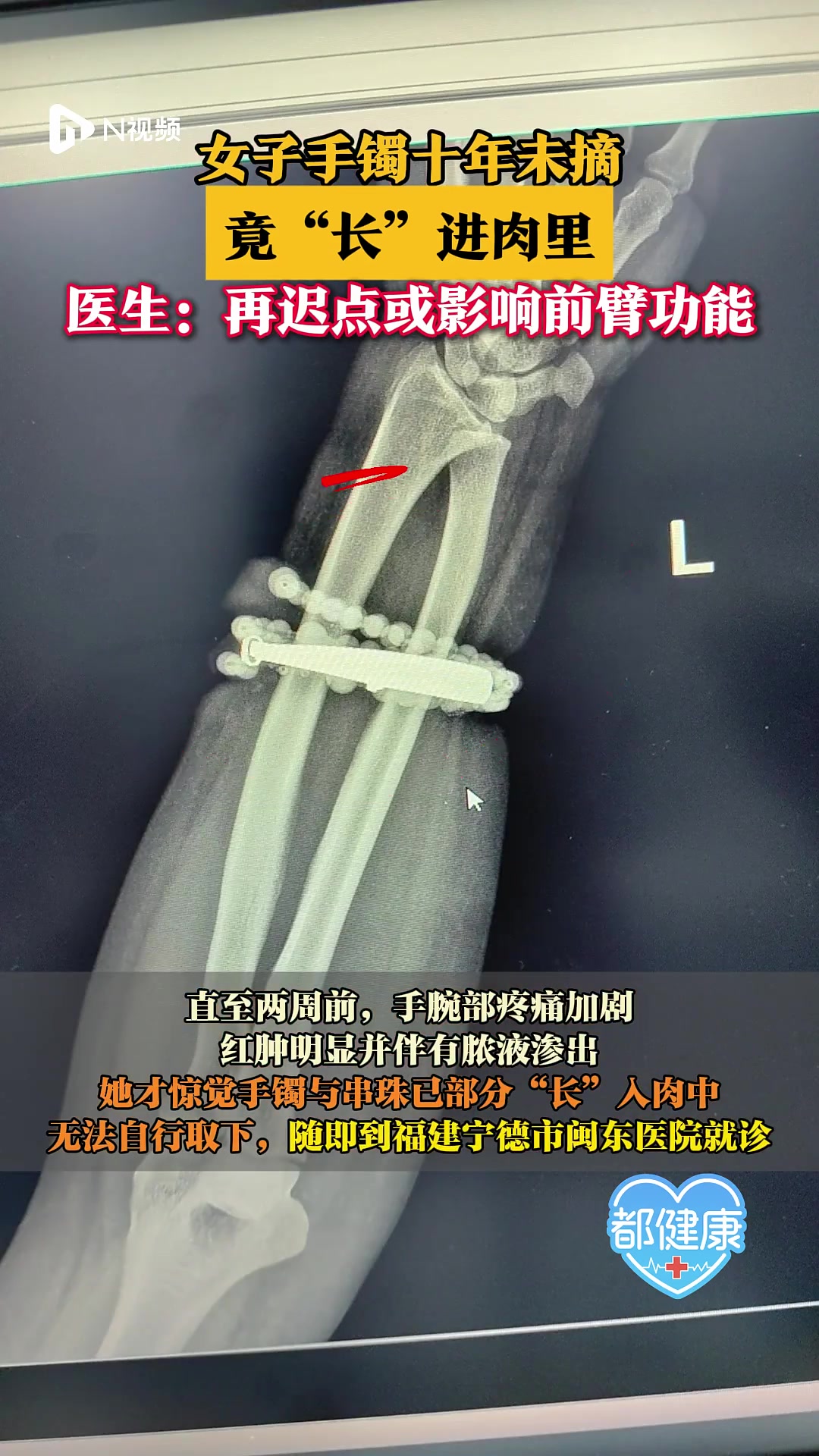 女子手镯十年未摘，竟“长”进肉里，医生提醒