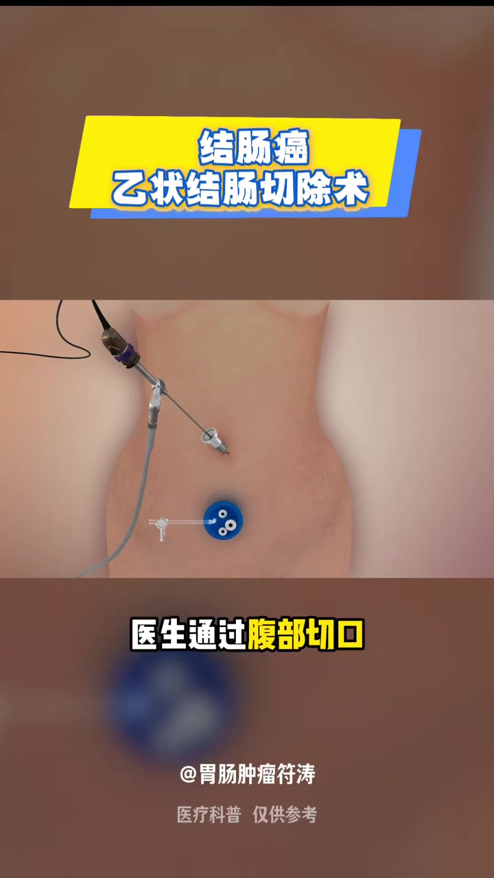 乙状结肠切除手术3D演示 抖出健康知识宝藏 健康科普破圈计划 医生科普 手术演示 肿瘤外科