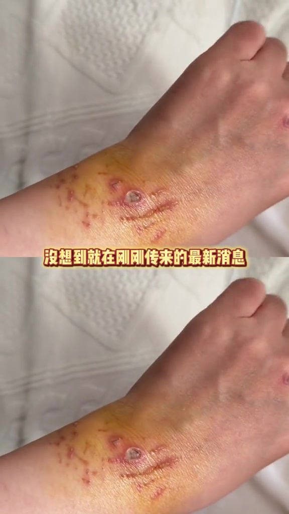 被鲨鱼咬的原博主伤口恶化 鲨鱼 马尔代夫 感染 万万没想到 后续