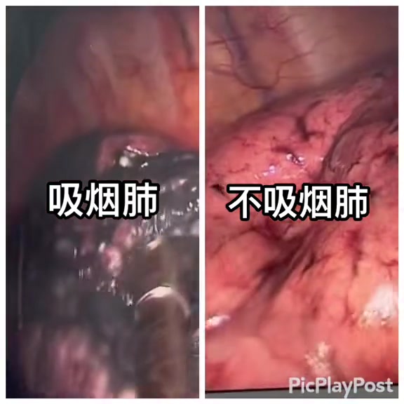 吸烟可以导致肺气肿、肺癌、喉癌、气管癌、消化道恶性肿瘤等。这个视频直观展示吸烟的肺的样子,