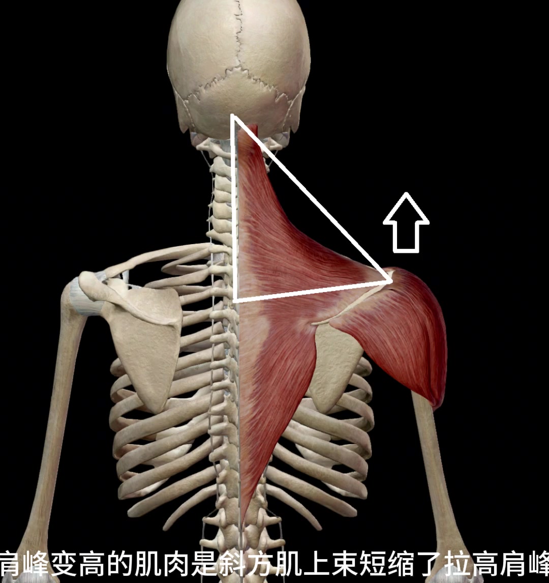 肩颈歪、肩峰高？竟是这几块肌肉短缩搞的鬼！