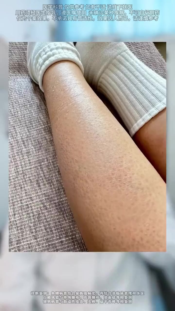 这三种看起来很可怕的皮肤病,其实根本不传染#牛皮癣 #白癜风 #鱼鳞病 #关爱健康 #健康