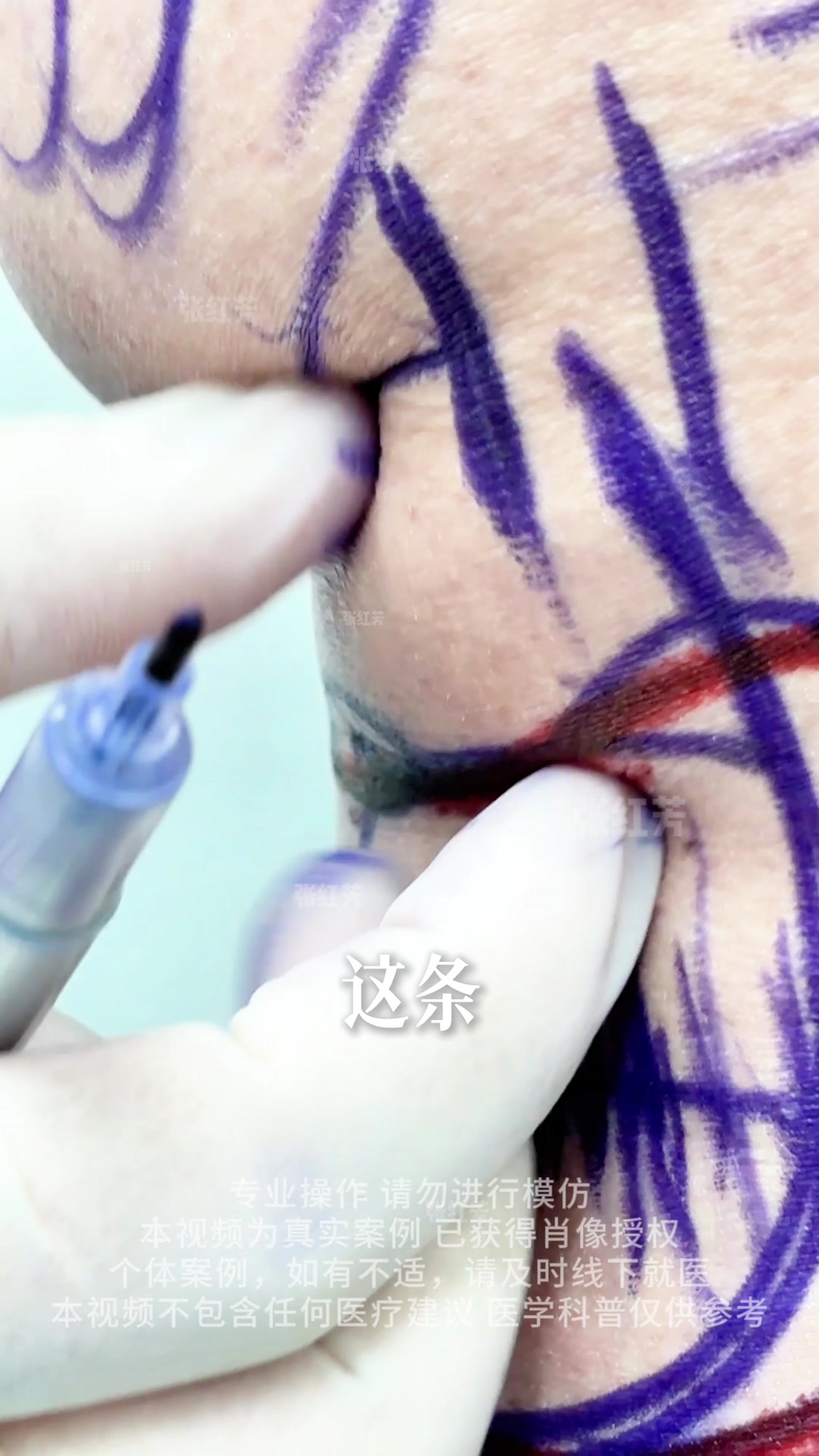 张红芳博士：大腿环吸后，为什么很多人都出现臀下垂问题，原因在这#吸脂修复#