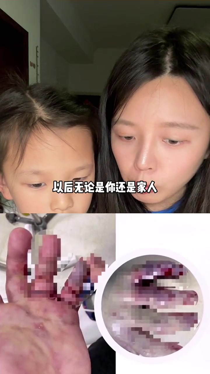 健康提醒：选鱼和处理鱼时务必小心！