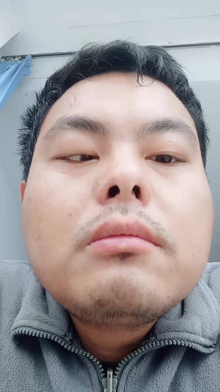 面瘫20天了,打针16天,针灸7天.昨天开始鼻子会动一点了