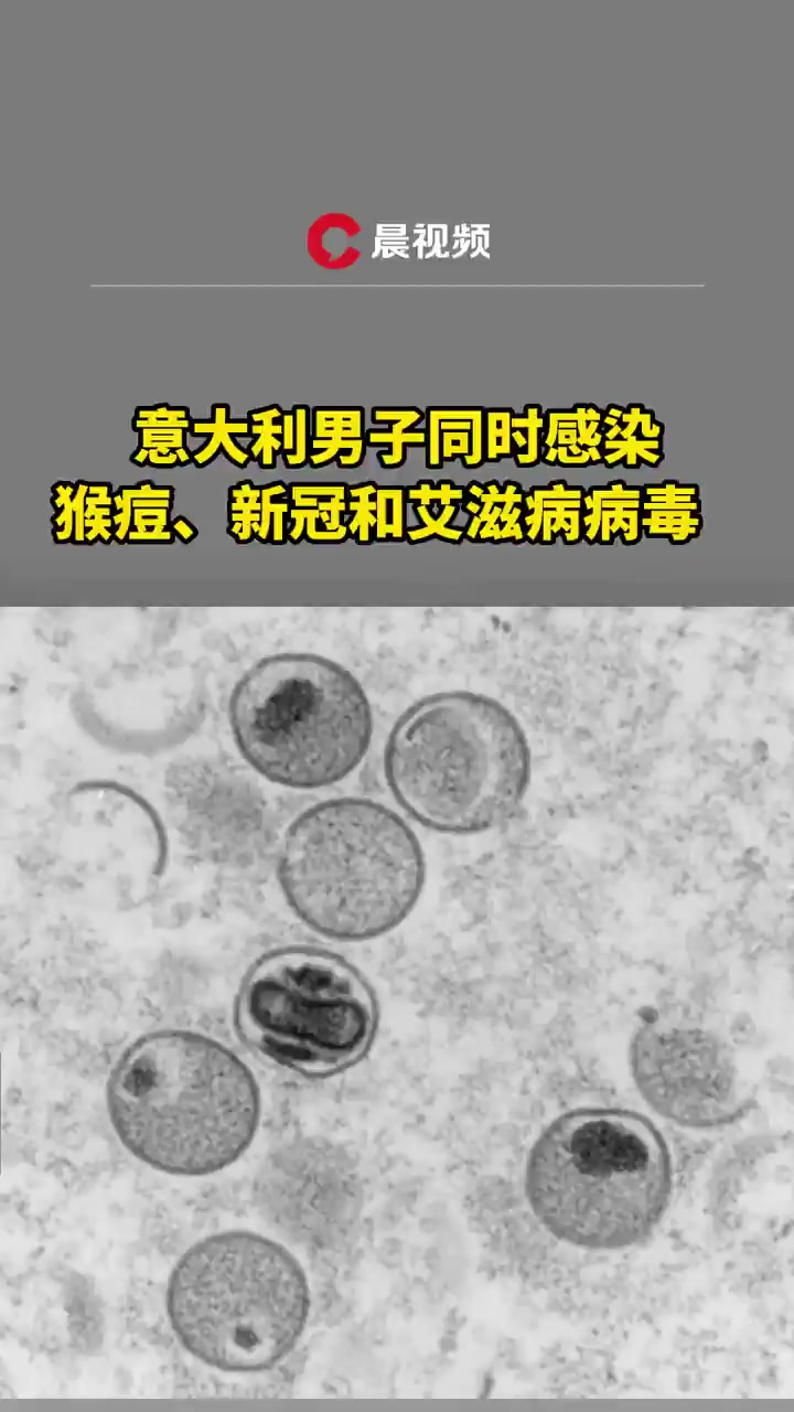 意大利男子同时感染猴痘,新冠和艾滋病病毒,为全球已知首例