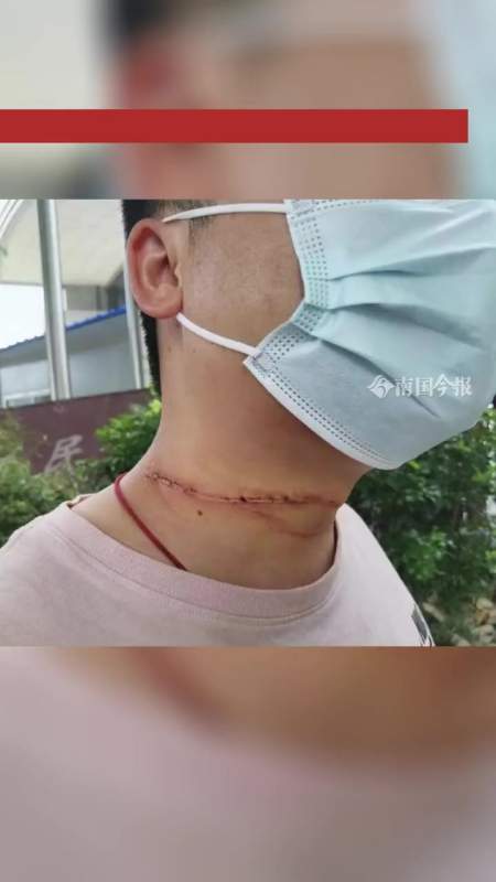 伤痕触目惊心南宁一男子骑电动车被风筝线割伤颈部伤口