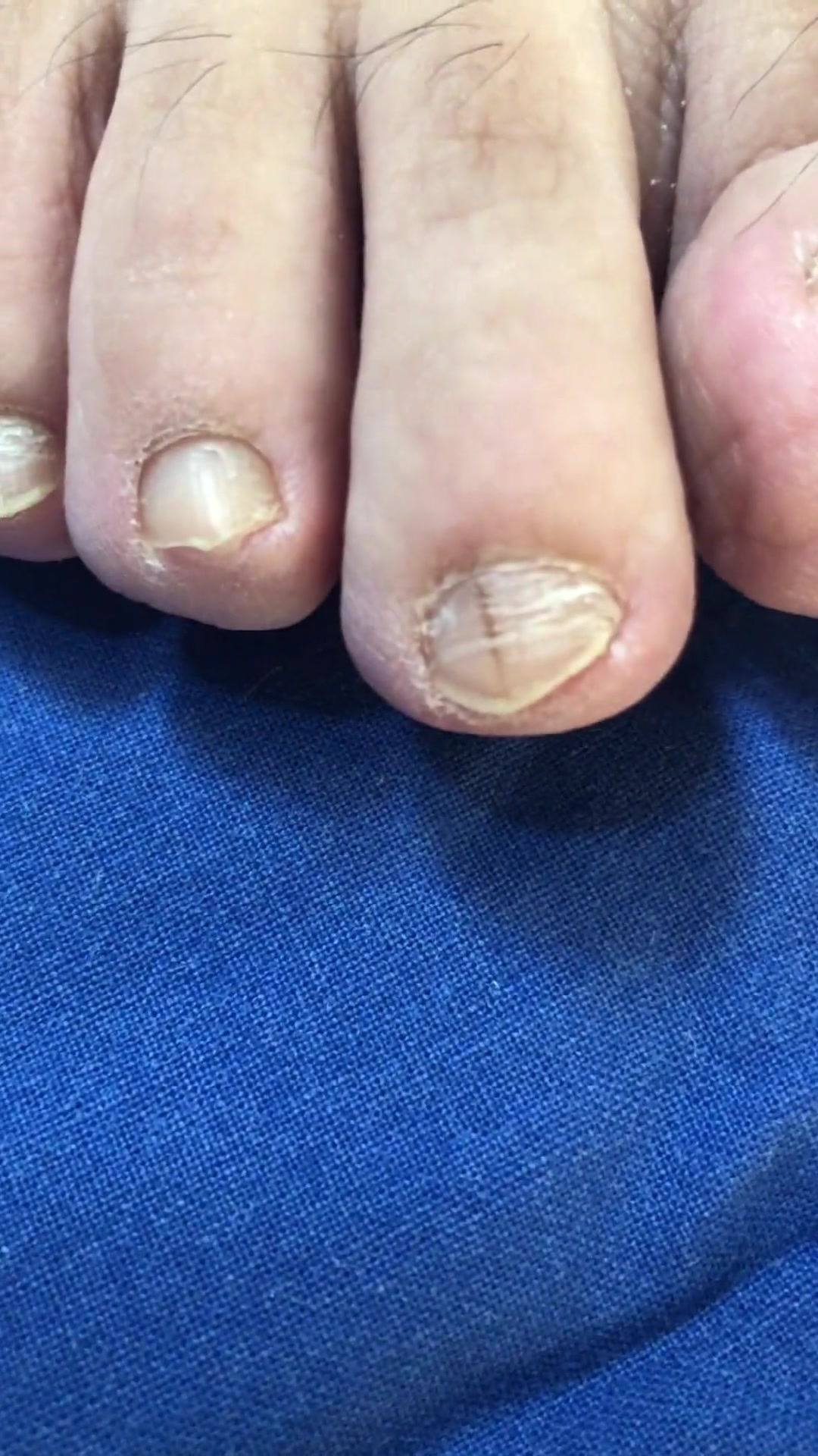 甲黑线?甲母痣?你能分的清吗?修脚 甲病 医学科普-度小视