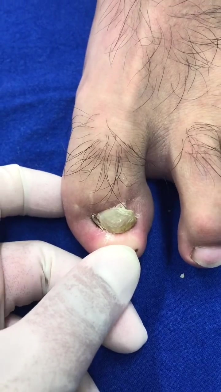 甲畸形一例(1),医生 甲病-度小视