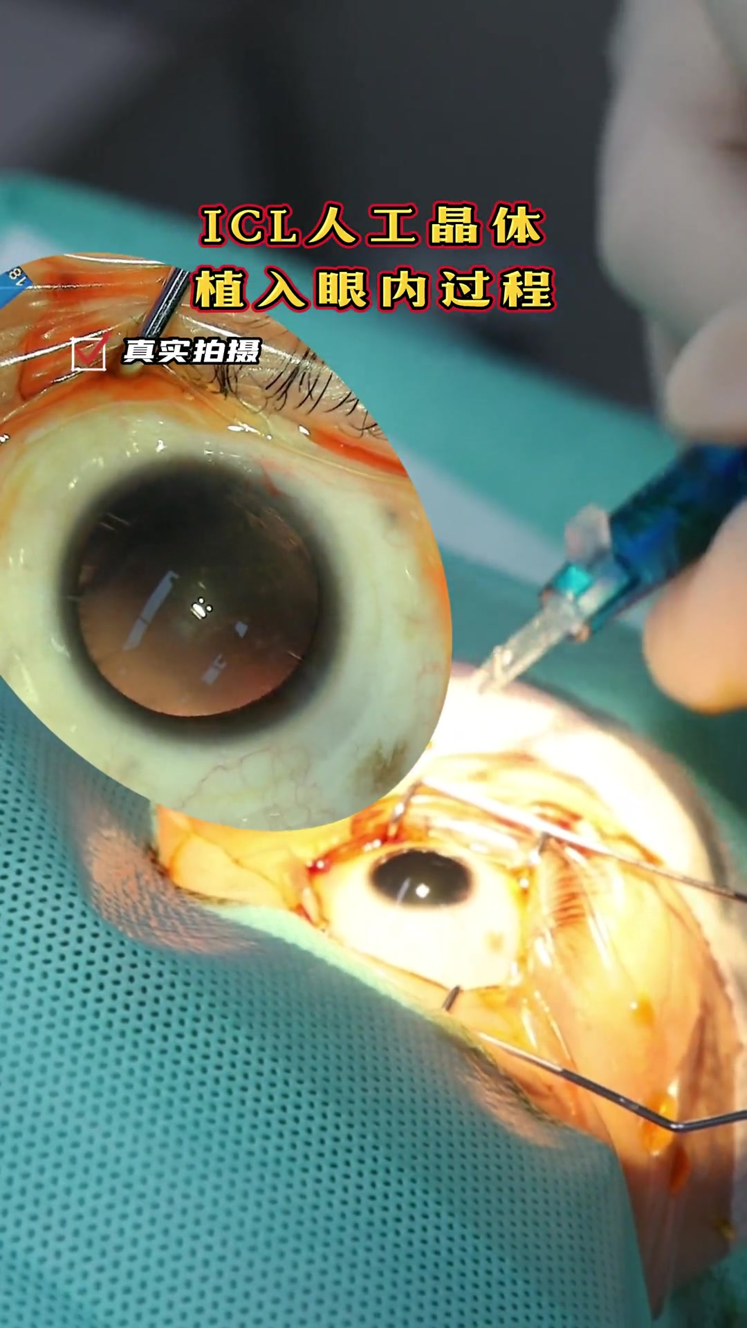 真实拍摄,icl植入眼内的过程 近视手术 晶体植入 icl晶体植入 icl-度