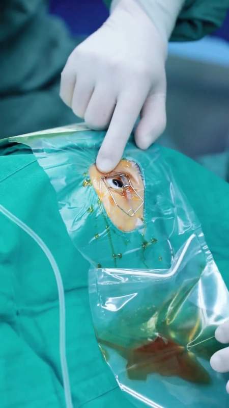 岁末将至,平安喜乐 近视手术 icl晶体植入 眼科医生杨云-度小视