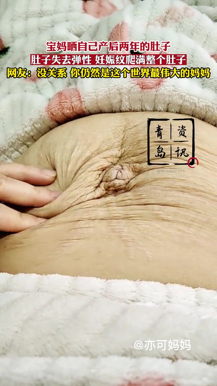 宝妈晒自己产后两年的肚子,肚子失去弹性,妊娠纹爬满整个肚子,网友:没