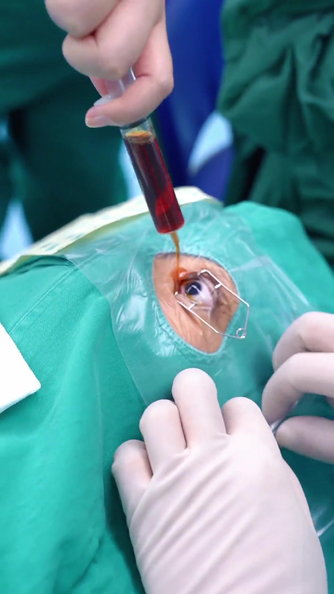 icl晶体植入,术中睫毛不会受到影响,有无菌贴膜 眼科医生杨云 眼科