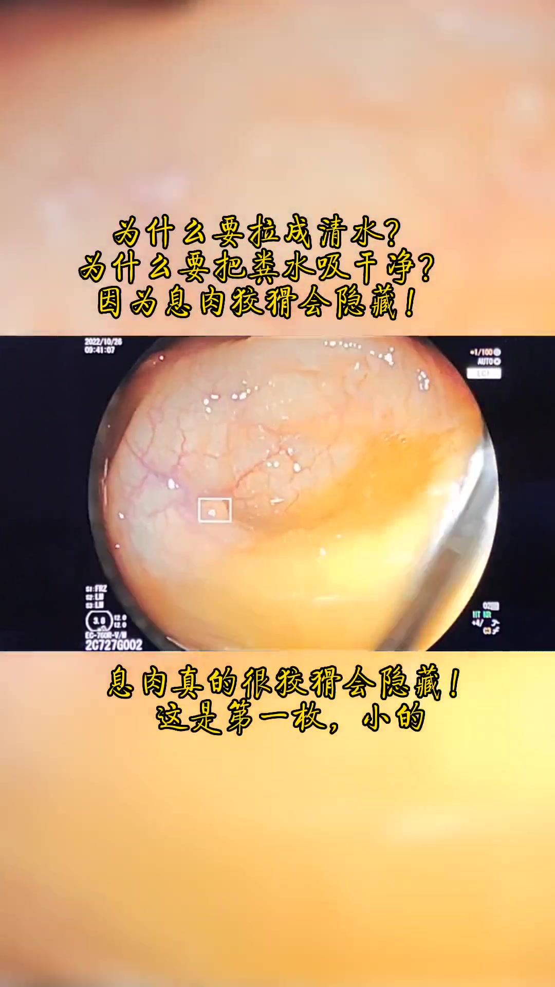 为什么肠镜下中要把粪水吸干净?因为肠道息肉真的很狡猾会隐藏!
