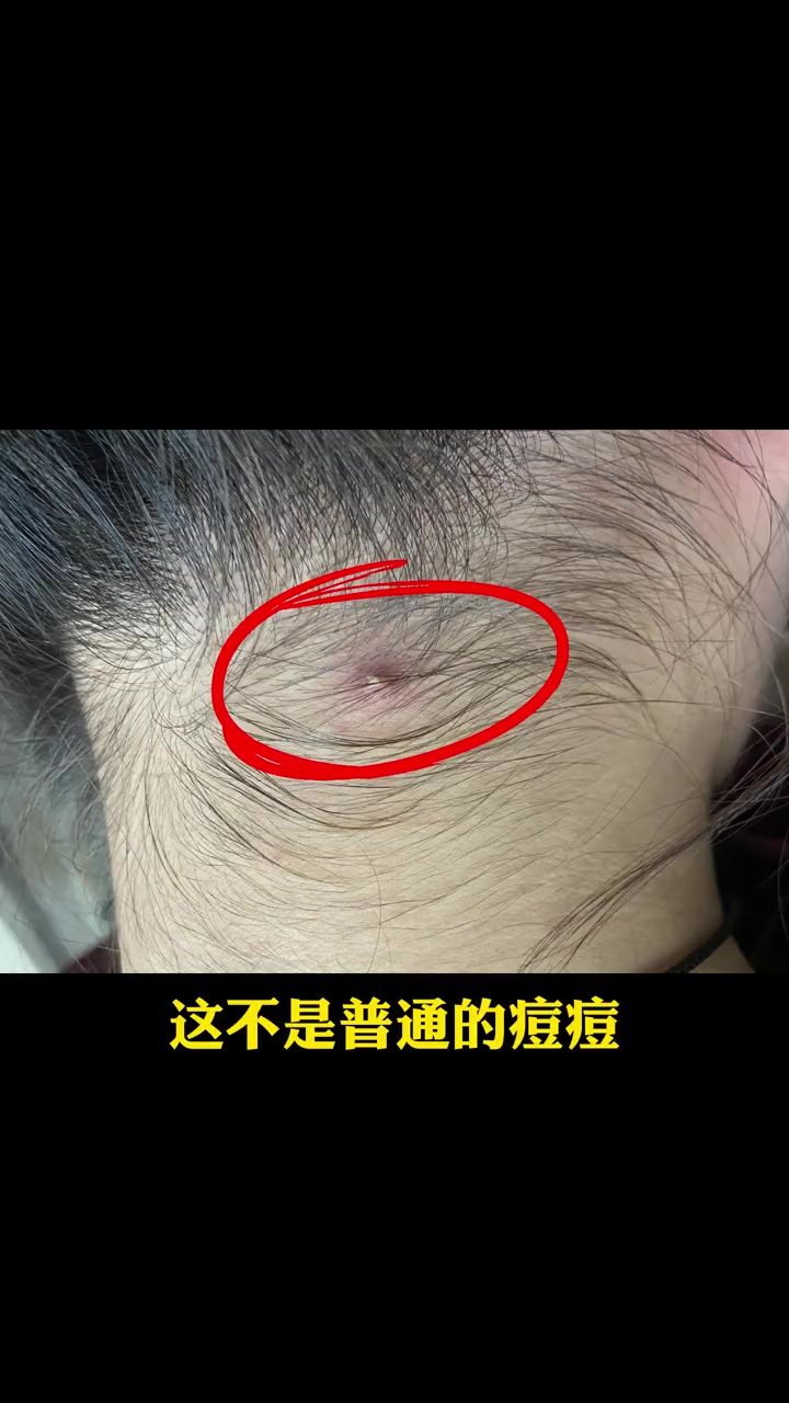 头上长的这个可不是普通的 痘痘,处理方法看这里 毛囊炎 医学科普