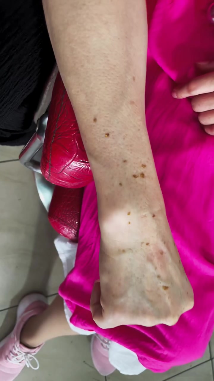 扁平疣长了十年二十年颜色会变咖黑色像斑一样,确实不太美观哦赶快