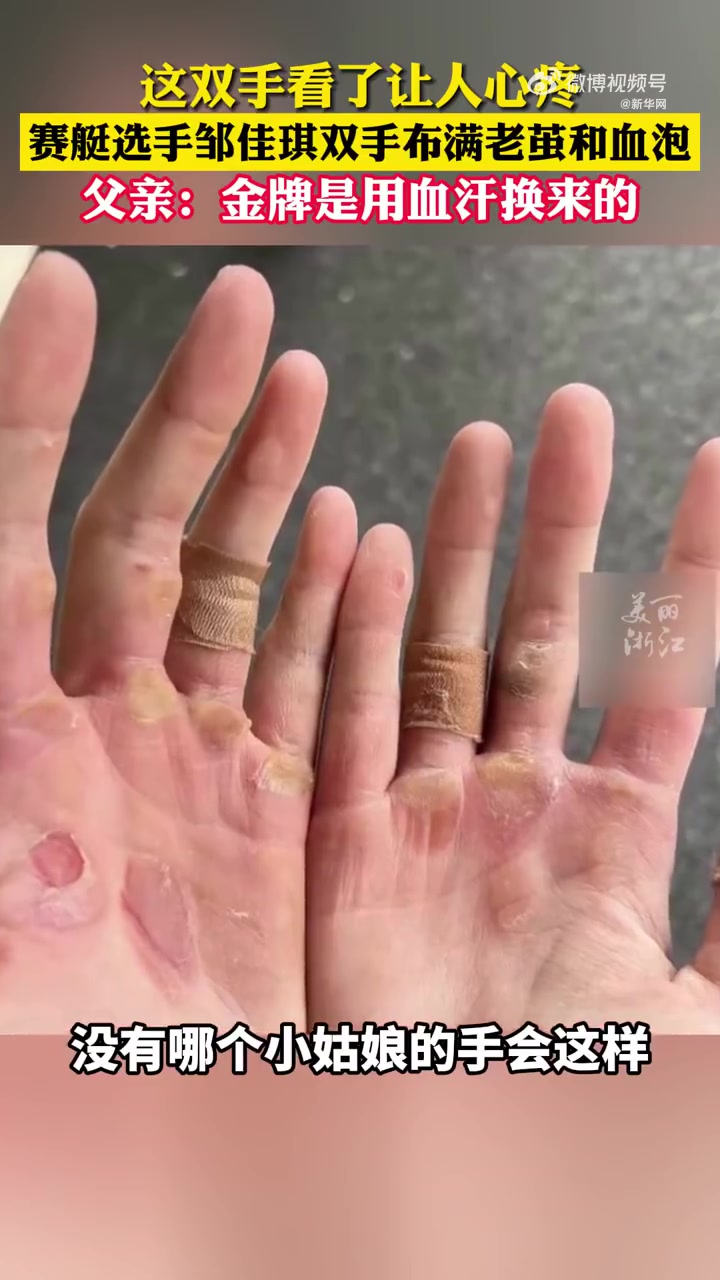 爸爸心疼邹佳琪双手都是硬茧赛艇选手双手布满老茧和血