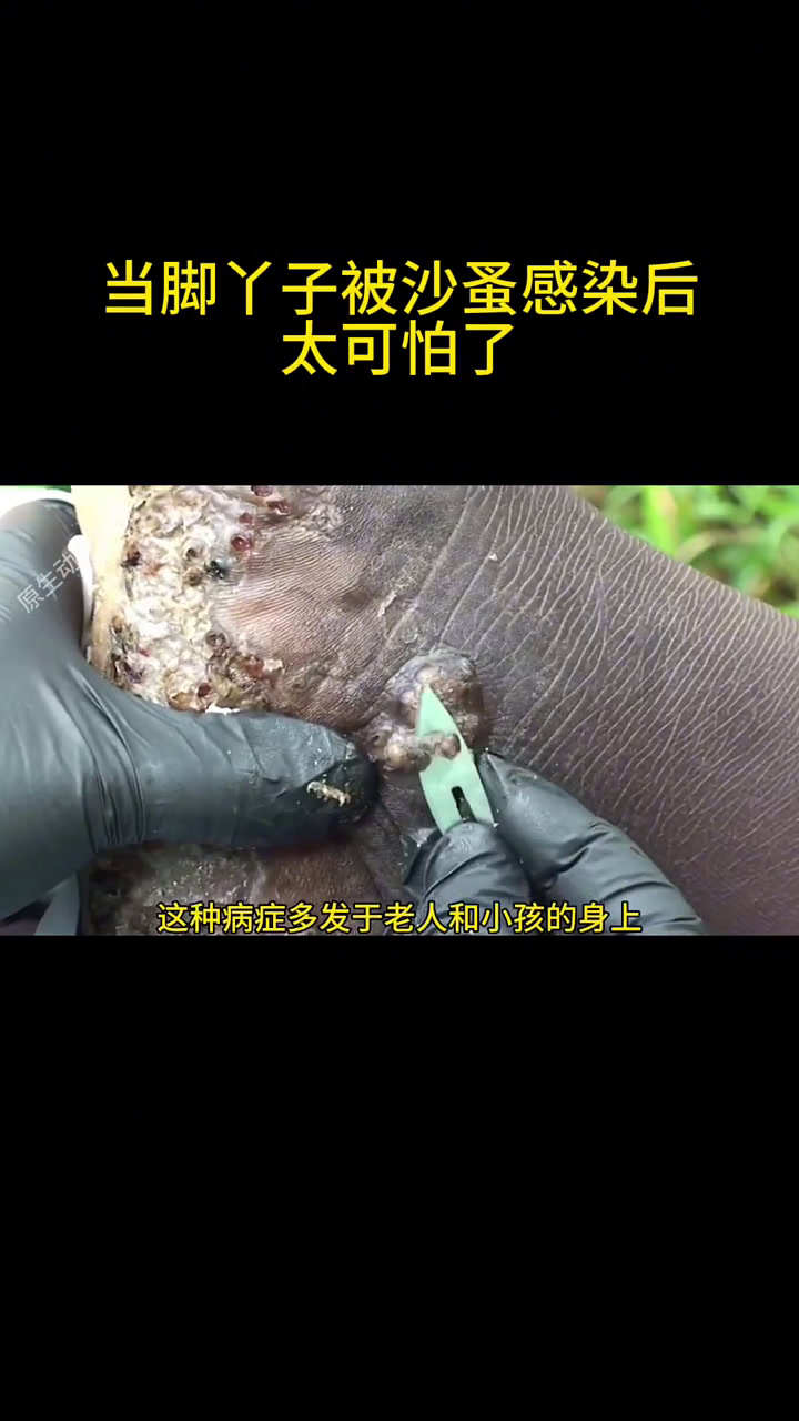 被沙蚤感染的脚修马脚蹄的视频
