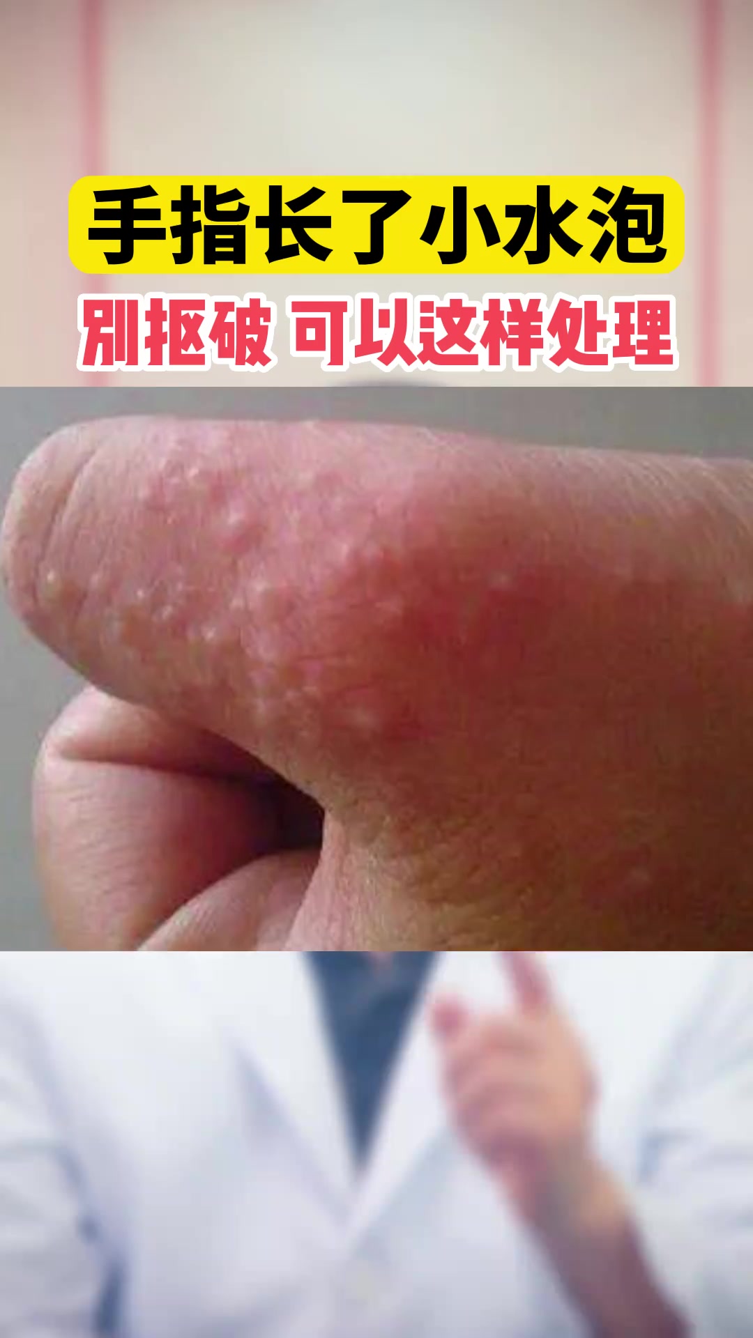 为什么会起水泡