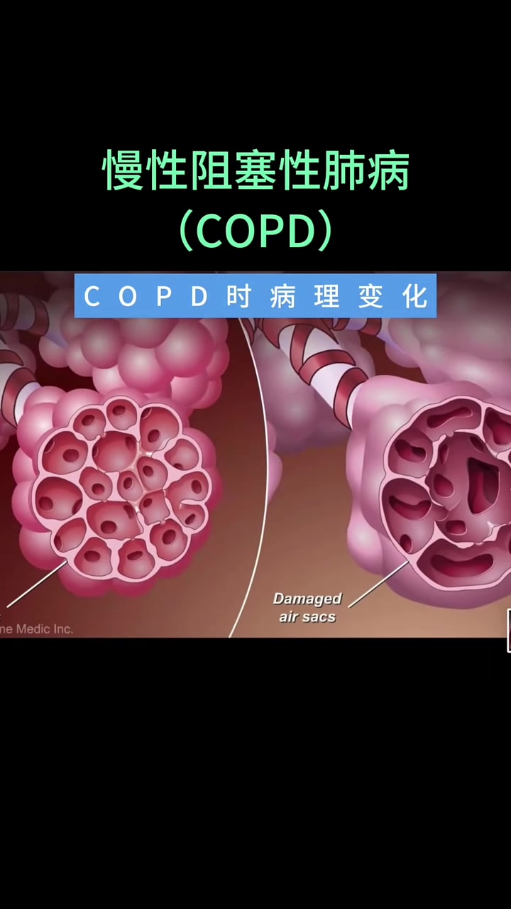 3d动画演示慢阻肺copd