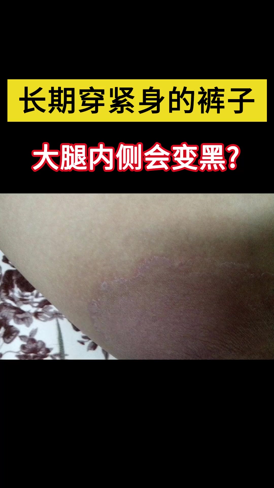 你知道长期穿紧身裤,大腿内侧有可能会变黑吗?冷知识 医学科普