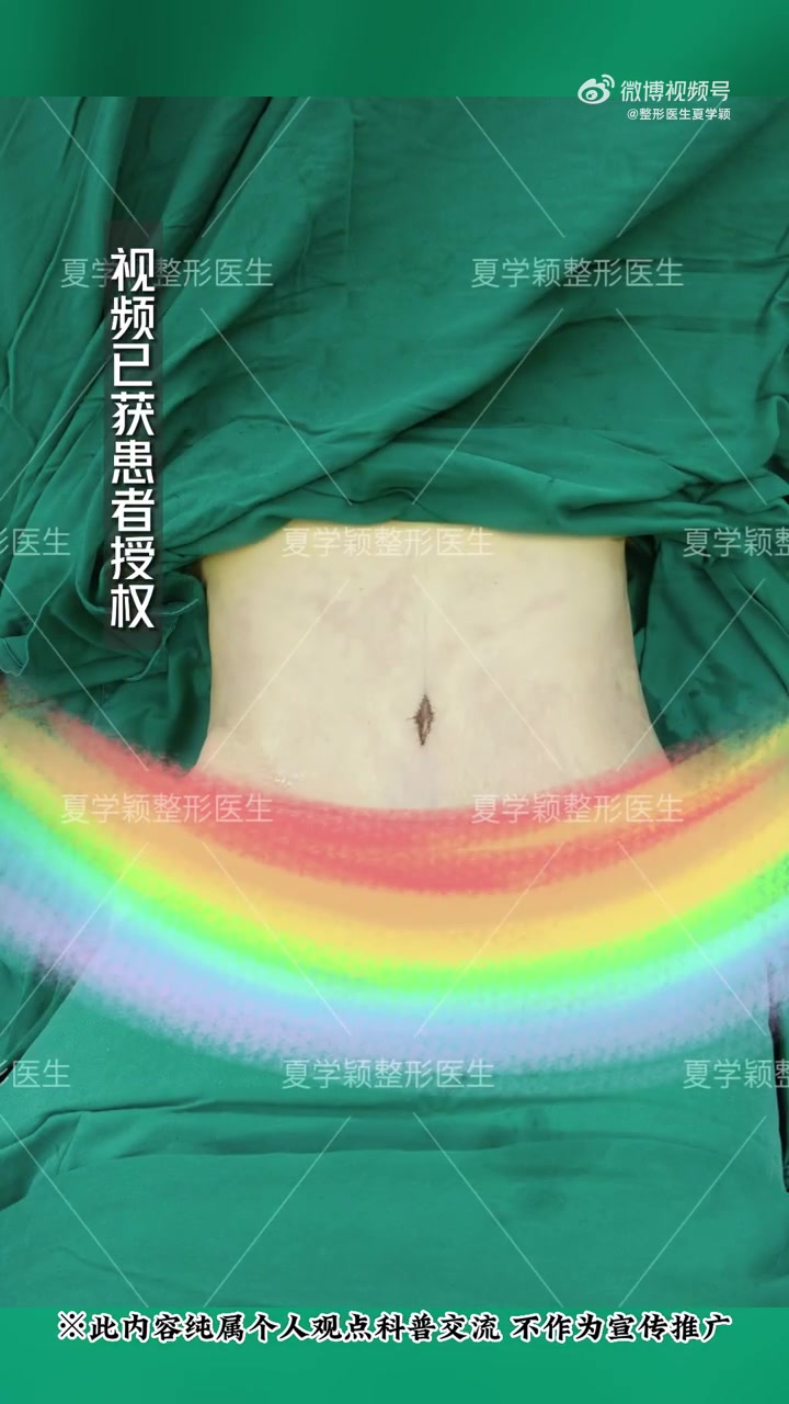 腹壁整形恢复后是这样子