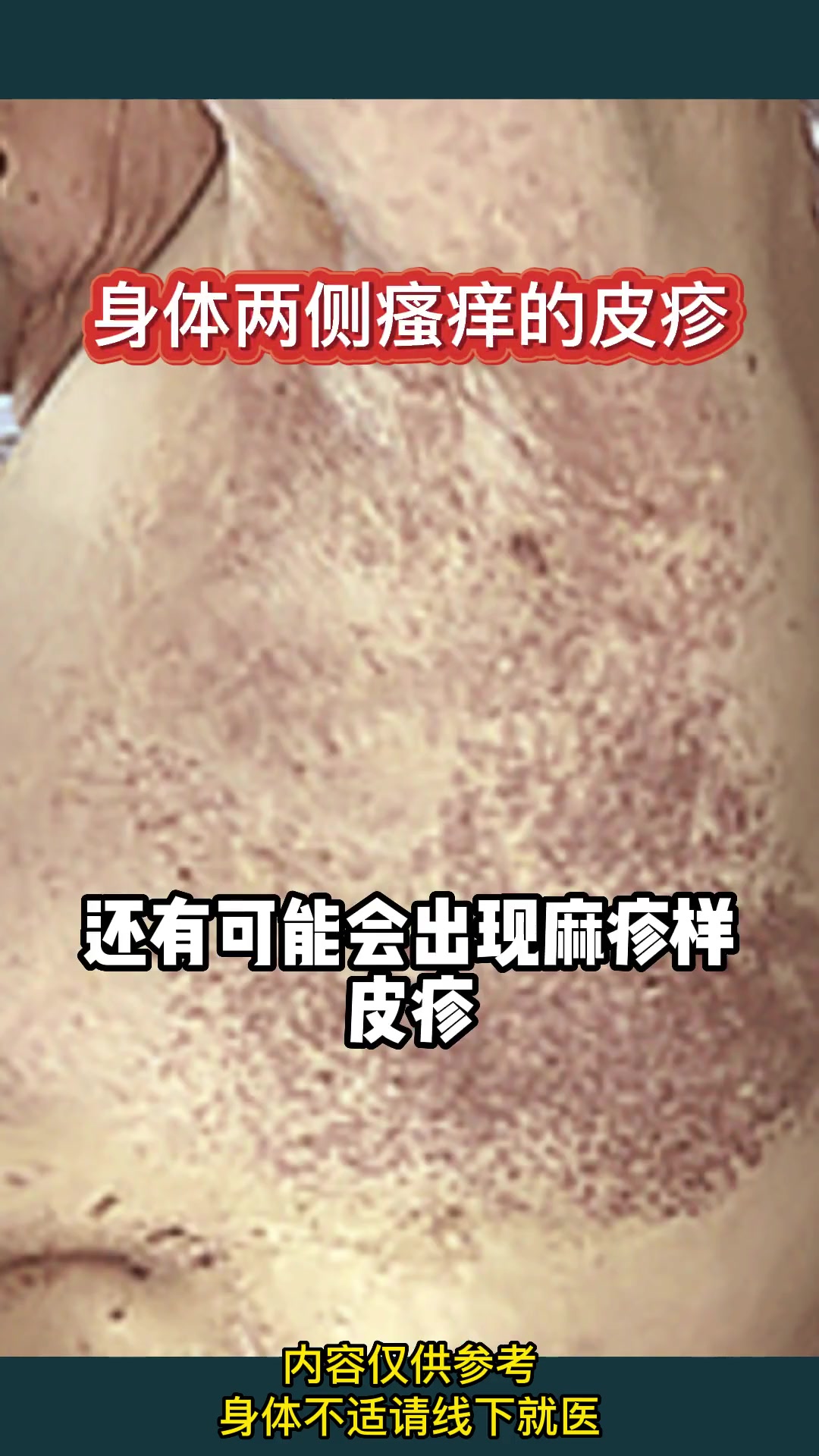 新冠肺炎病毒感染的皮肤表现 医学科普 防疫须知 为了自己和家人的