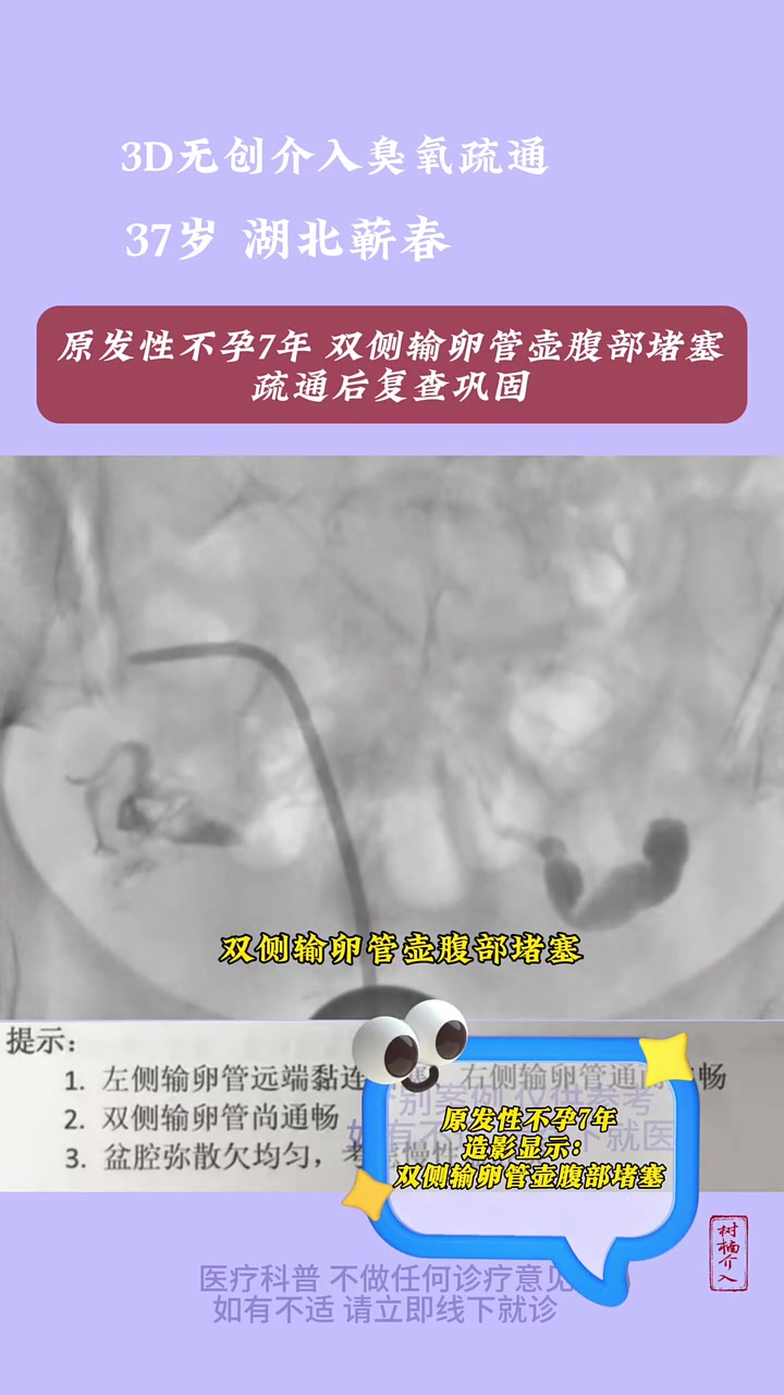 原发性不孕7年双侧输卵管壶腹部堵塞疏通后复查巩固