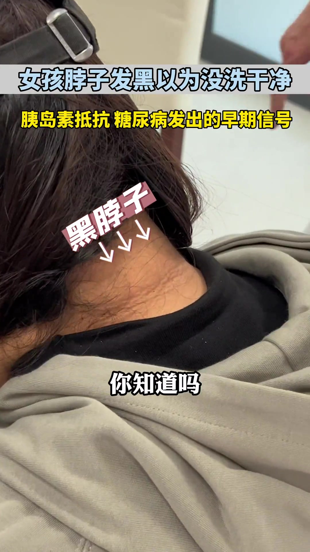 女孩脖子发黑以为没洗干净 黑棘皮 胰岛素抵抗 科学减肥 糖尿病 减重