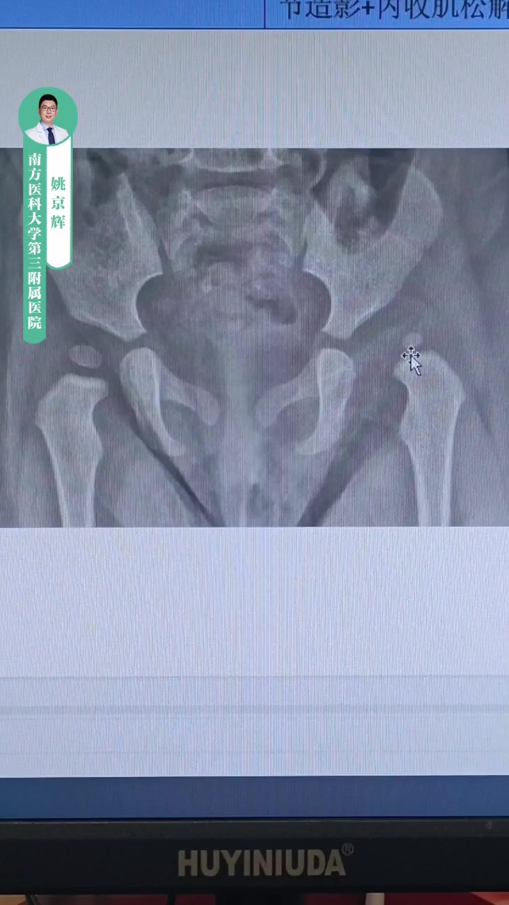 18个月内孩子发现髋关节脱位,通常选择保守治疗,石膏固定,支具固定 髋