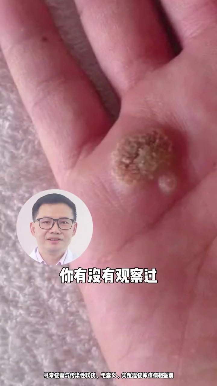 医学科普 寻常疣 hpv