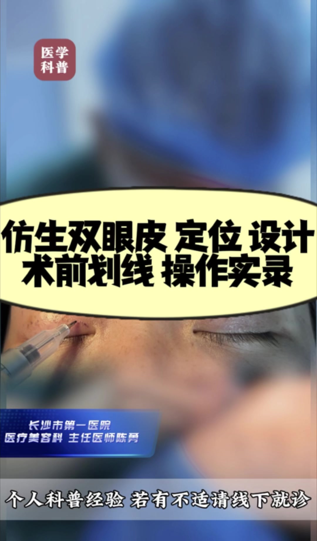 仿生双眼皮手术面诊定位划线设计 实录