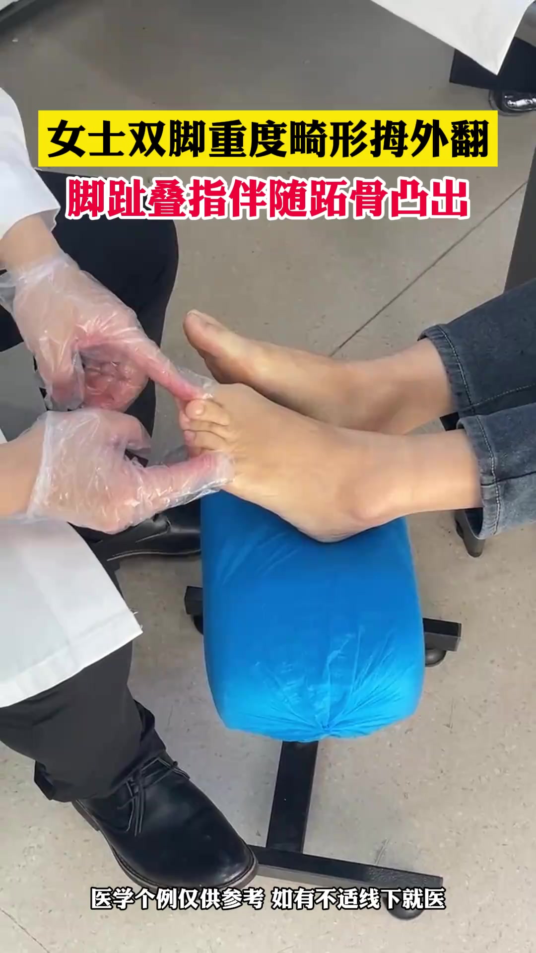 女士双脚重度畸形拇外翻,脚趾叠趾伴随跖骨凸出