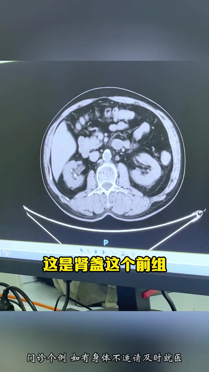 67岁大哥肾结石,ct病例查看结石