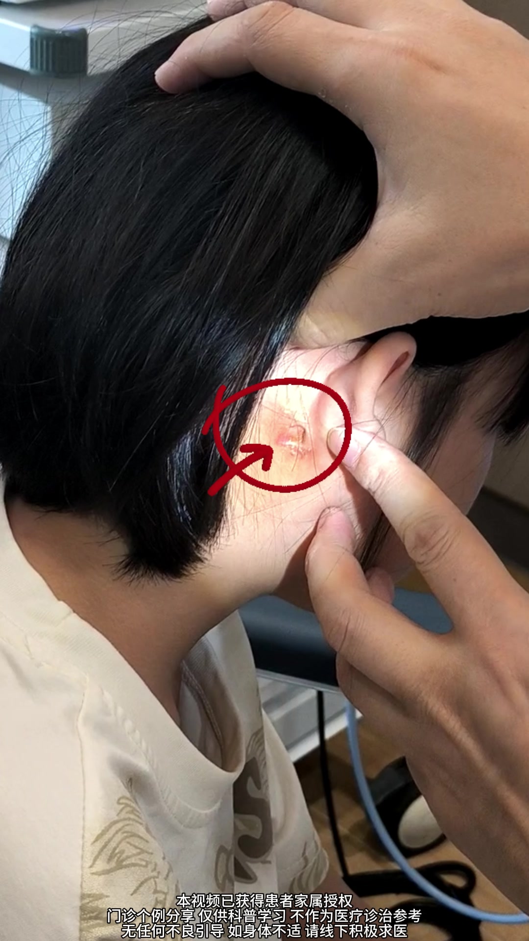 孩子出生耳朵有个小孔,耳后出现反复的脓肿