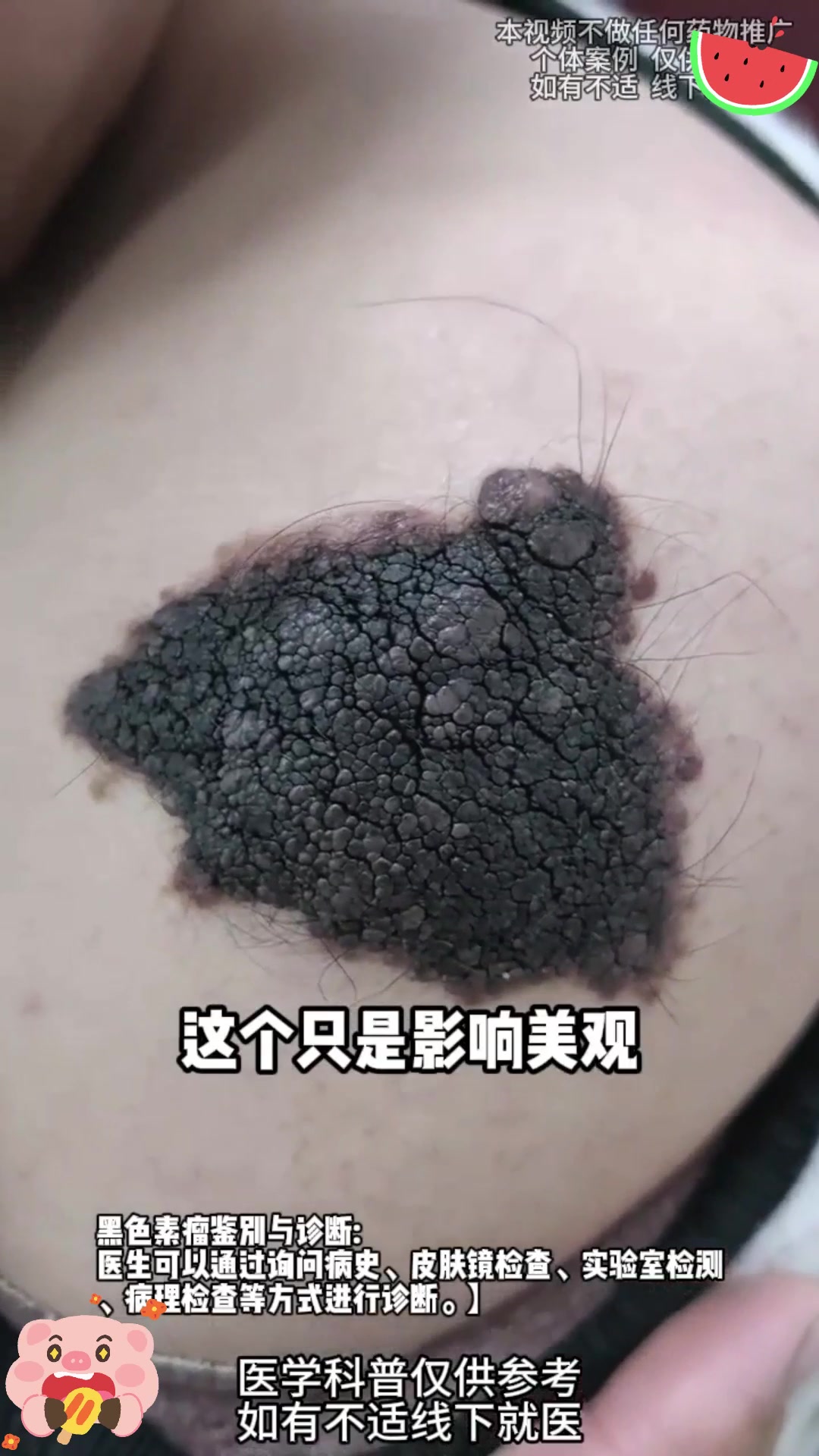 男孩天生"兽皮痣",面积达 90%!