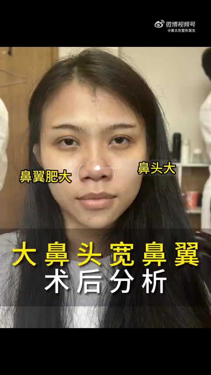 大鼻头,宽鼻翼术后分析姜太东 隆鼻 鼻综合整形 鼻模板