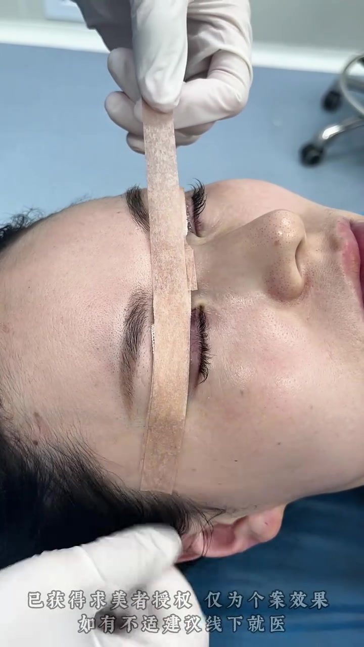 揭秘双眼皮术后包扎全流程