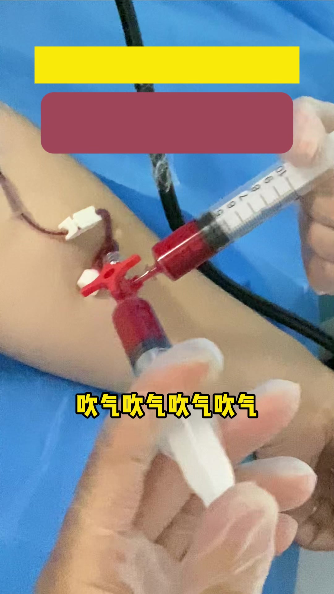 头疼原因找不到,所有检查都没问题,那可以做个发泡实验