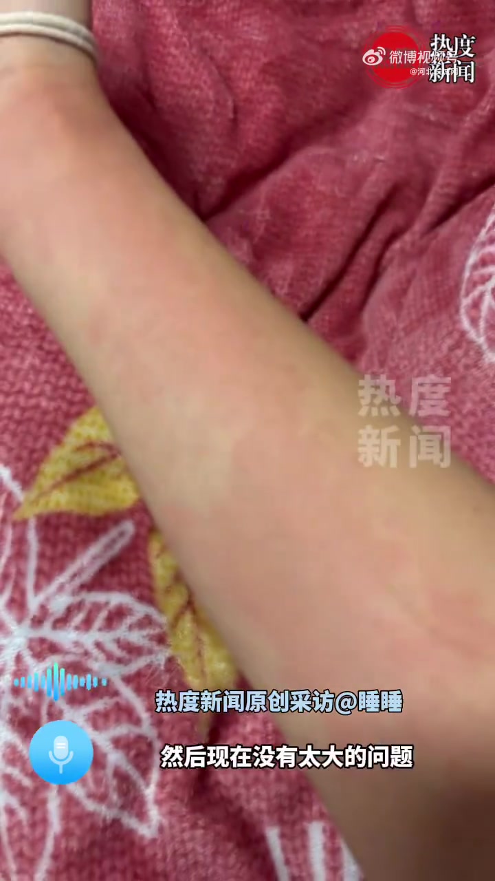 得了急性荨麻疹,目前已无大碍,希望大家能冷空气过敏凉席过敏症状图片