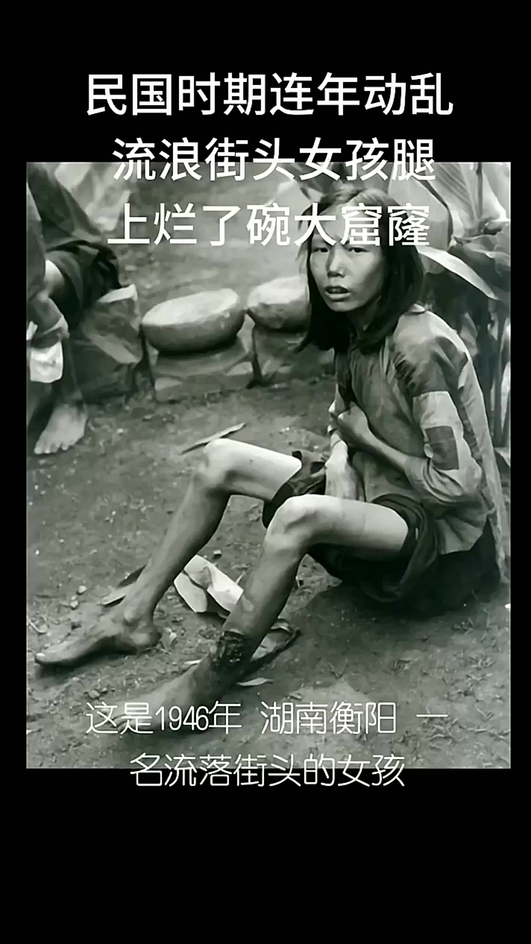 民国时期连年动乱 流浪街头女孩腿上烂了碗大窟窿