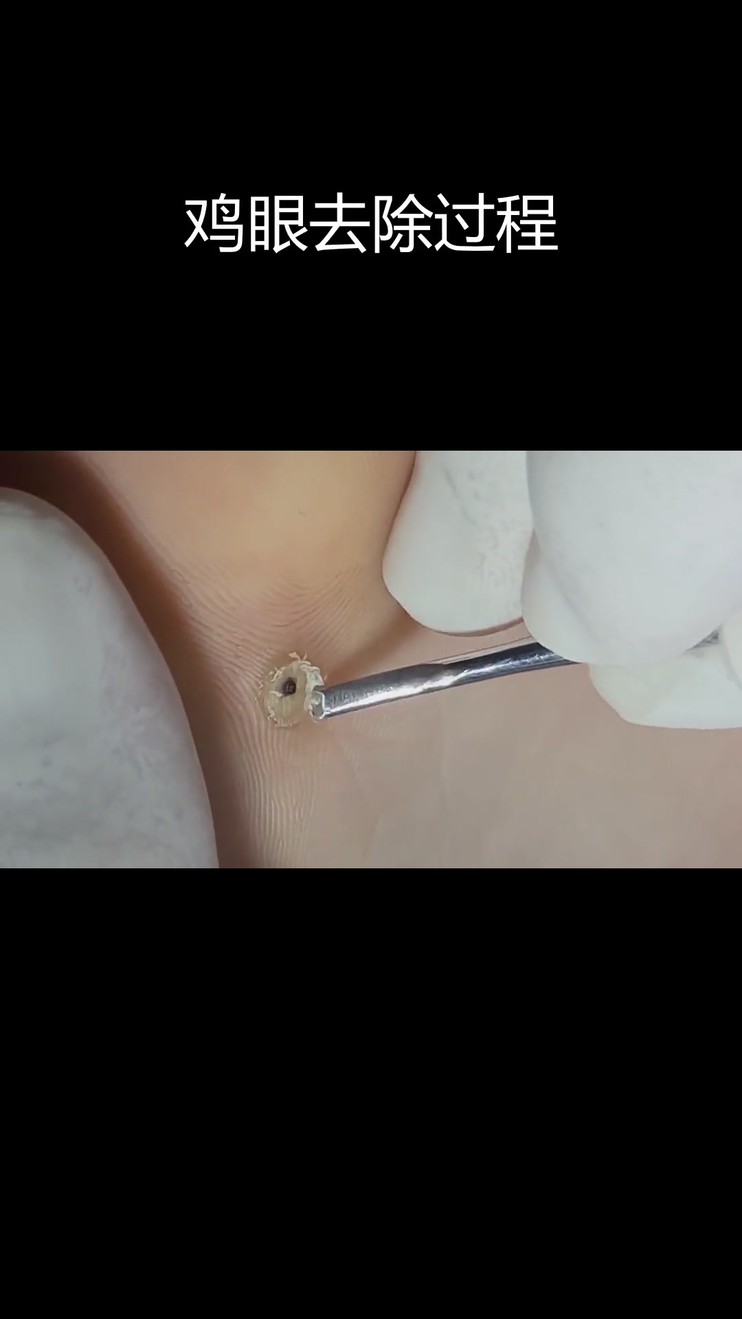 脚部鸡眼清理全过程,医生耐心处理