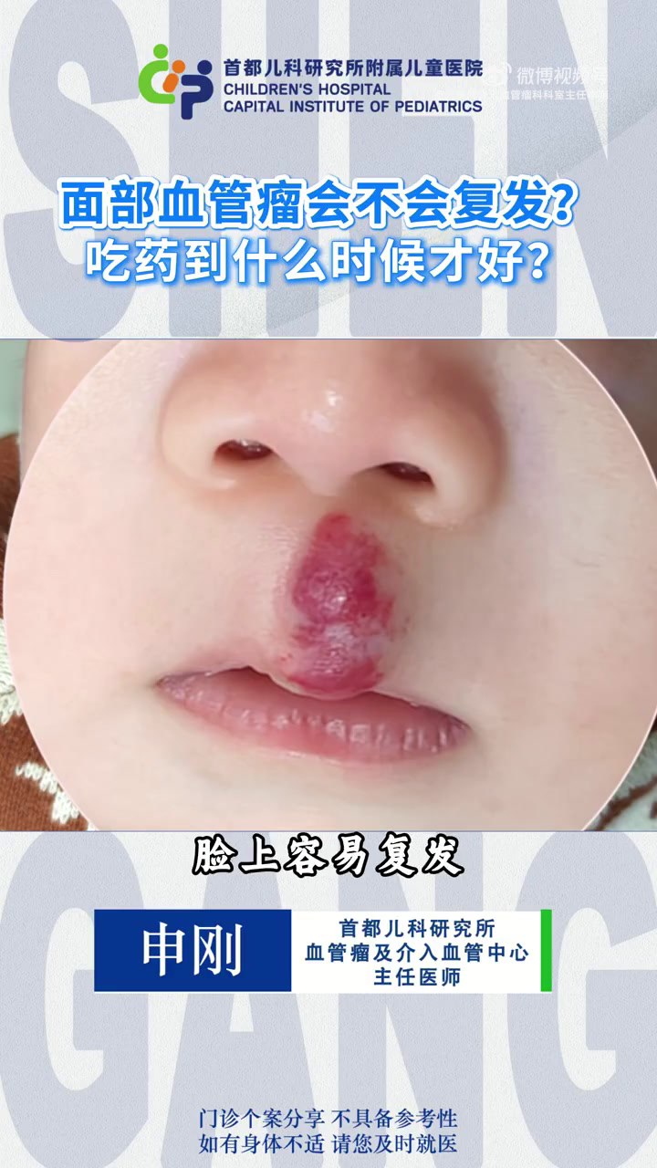 面部血管瘤会不会复发?吃药到什么时候才好?