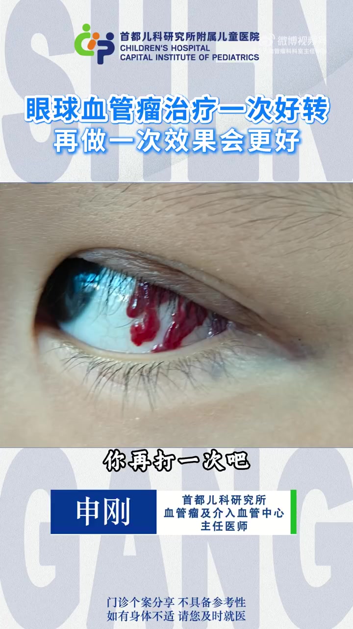 眼球血管瘤治疗一次好转 再做一次效果会更好