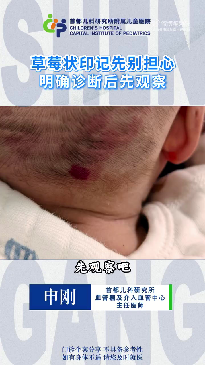 草莓状印记先别担心 明确诊断后先观察