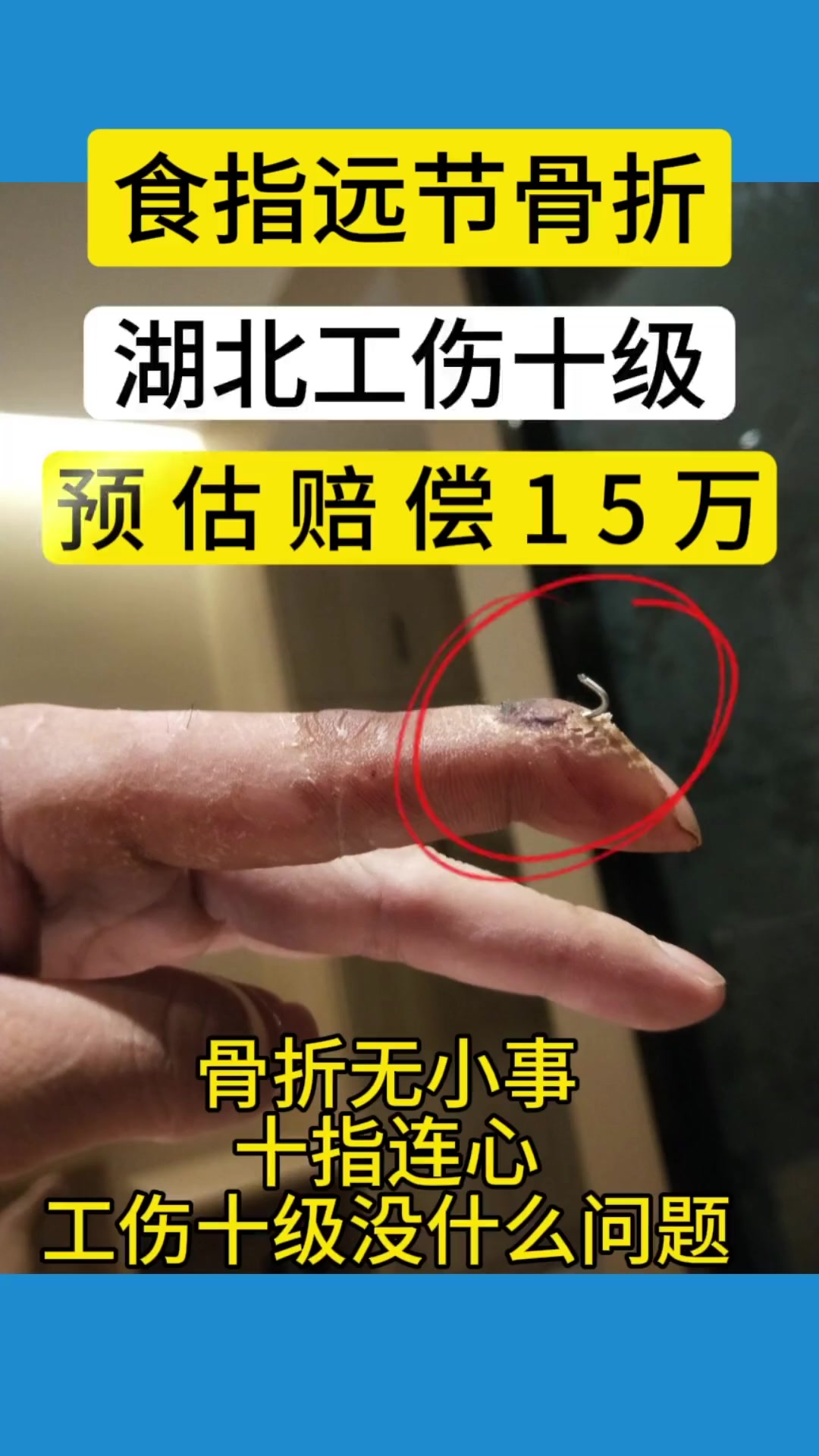 食指远节骨折工伤十级,湖北赔偿15万