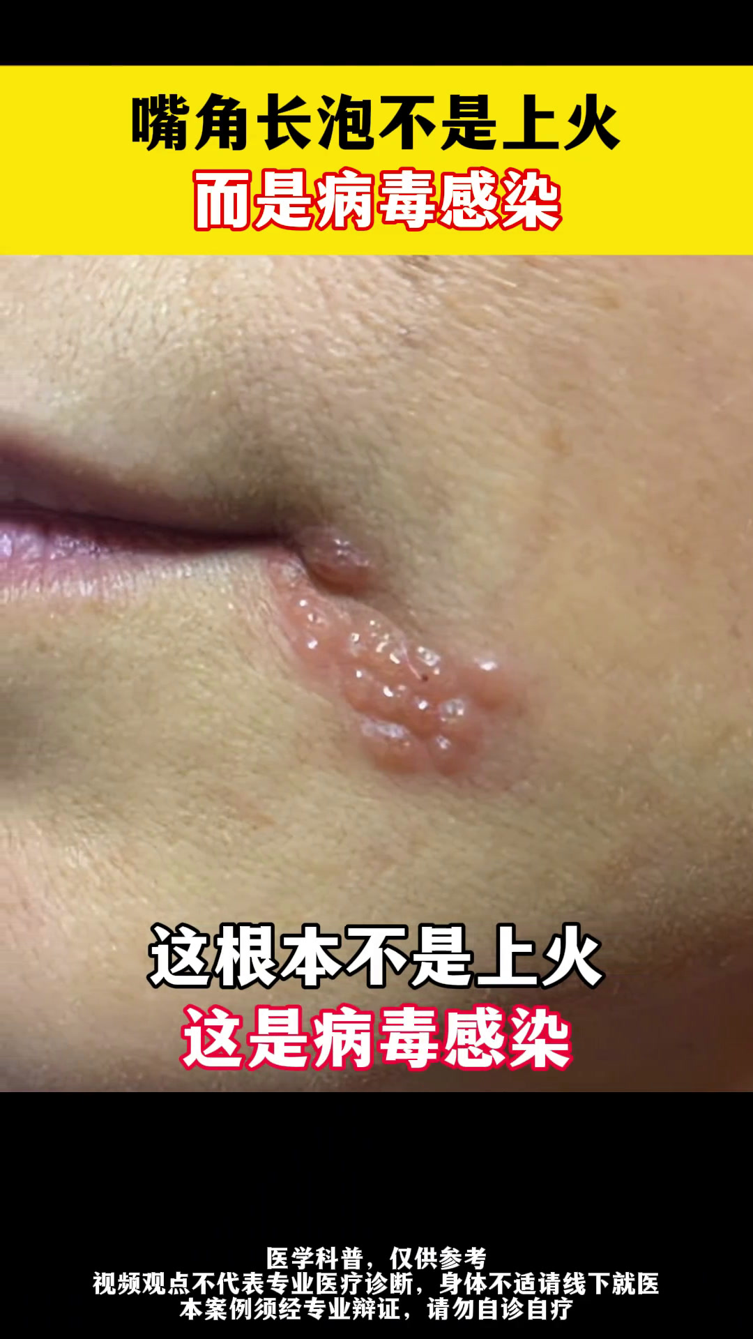 嘴角长泡不是上火,而是病毒感染