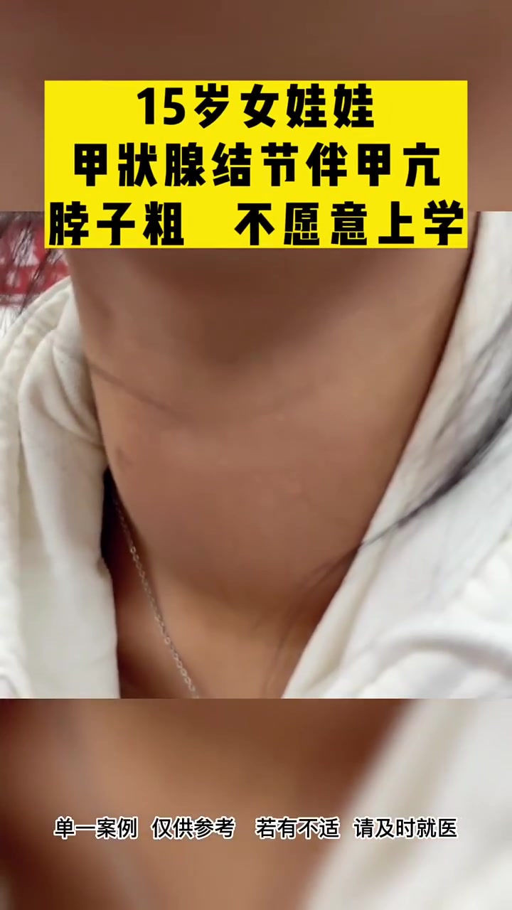 小女孩 甲亢 多年,脖子粗,去了很多医院治疗但效果都不好,身体的不适